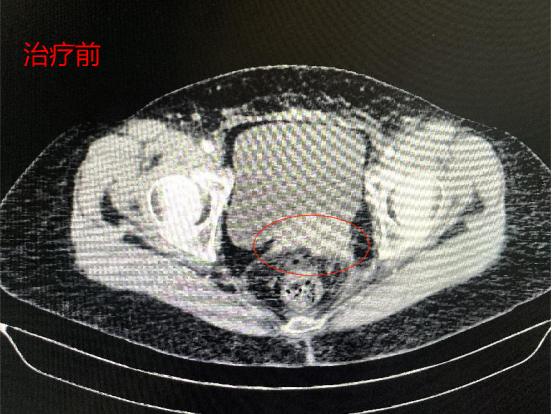 宮頸癌復發(fā)腎功能受影響放粒子加介入2個月重燃希望