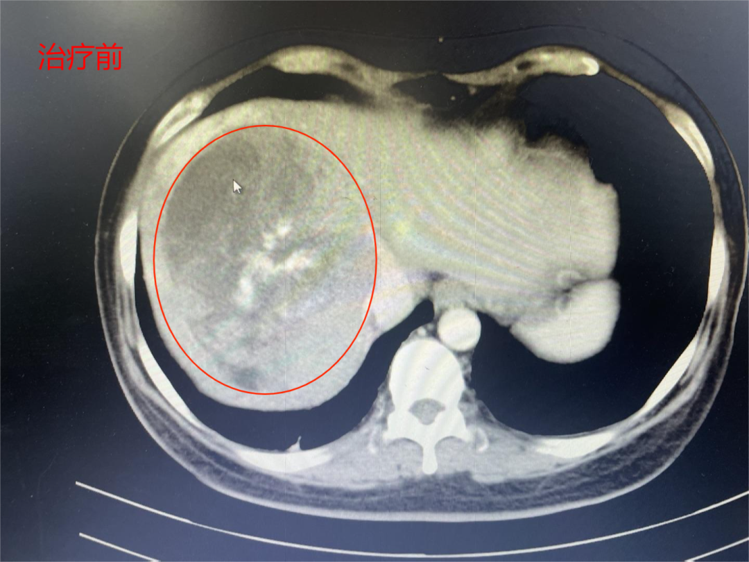 【肝癌巨型腫瘤】甲胎蛋白值高達(dá)11萬(wàn)，介入7個(gè)療程，甲胎蛋白降至32