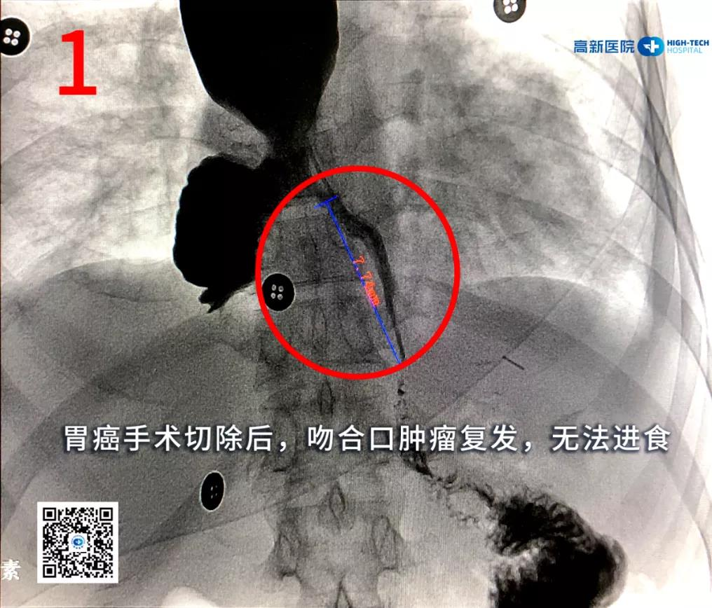 【胃癌】一位胃癌晚期患者從命懸一線(xiàn)到正常生活，幸運(yùn)絕非偶然！